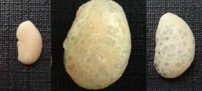 Photos of kidney cysts