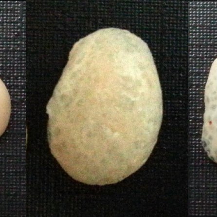 Photos of kidney cysts