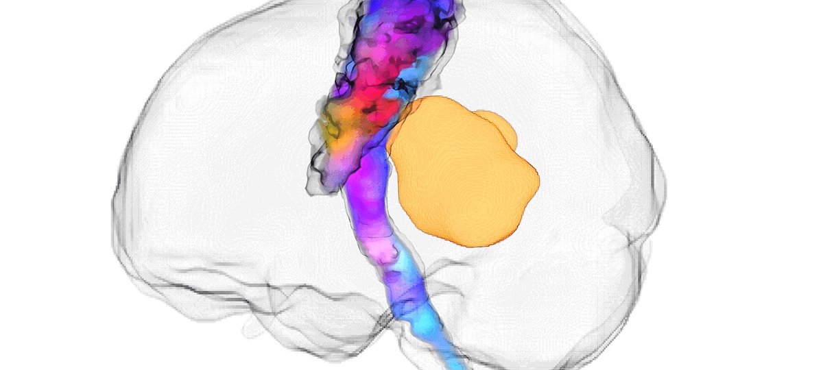 A grey, transparent, outline of the human brain is pictured. Within the brain a colourful bundle of nerve fibres, blue, purple, red and yellow, is present from the base of the brain through the centre. To the right of the bundle is a yellow tumour, which is around one fifth of the size of the brain.