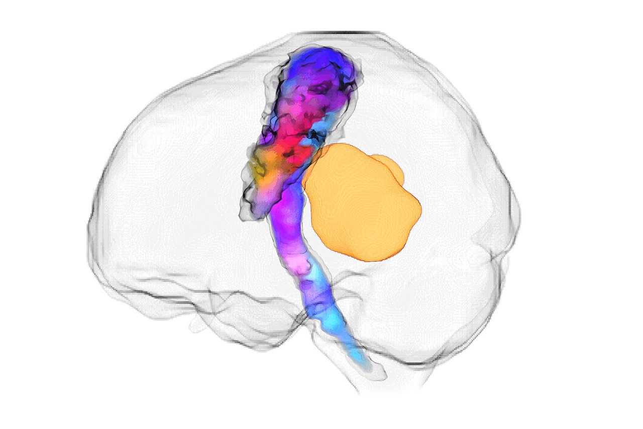 A grey, transparent, outline of the human brain is pictured. Within the brain a colourful bundle of nerve fibres, blue, purple, red and yellow, is present from the base of the brain through the centre. To the right of the bundle is a yellow tumour, which is around one fifth of the size of the brain.