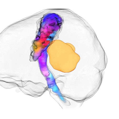 A grey, transparent, outline of the human brain is pictured. Within the brain a colourful bundle of nerve fibres, blue, purple, red and yellow, is present from the base of the brain through the centre. To the right of the bundle is a yellow tumour, which is around one fifth of the size of the brain.