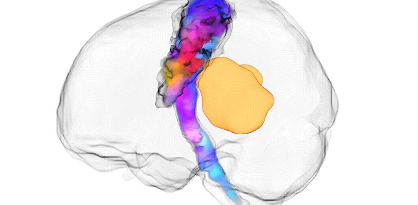 A grey, transparent, outline of the human brain is pictured. Within the brain a colourful bundle of nerve fibres, blue, purple, red and yellow, is present from the base of the brain through the centre. To the right of the bundle is a yellow tumour, which is around one fifth of the size of the brain.
