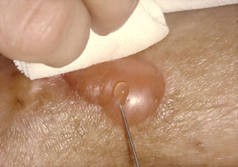 An image of a blister being popped with a needle