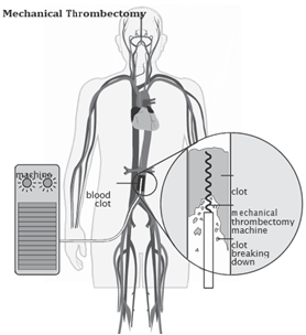 A diagram of a human body Mechanical thrombectomy – using tiny surgical tools, the doctor breaks down the clot into smaller pieces that can then be sucked out of the blood.