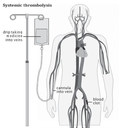 A human body showing systemic thrombolysis – a clot-busting medicine is given through a cannula (thin plastic tube) into a vein in your child’s hand or foot. The medicine travels through the blood vessels breaking up clots elsewhere in the body.