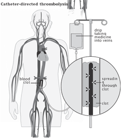 A diagram of a human body showing Catheter-directed thrombolysis – the clot-busting medicine is delivered into the centre of the clot over several hours or days. The medicine is given through a larger cannula inserted into the clot in a short procedure under general anaesthetic in the IR department.