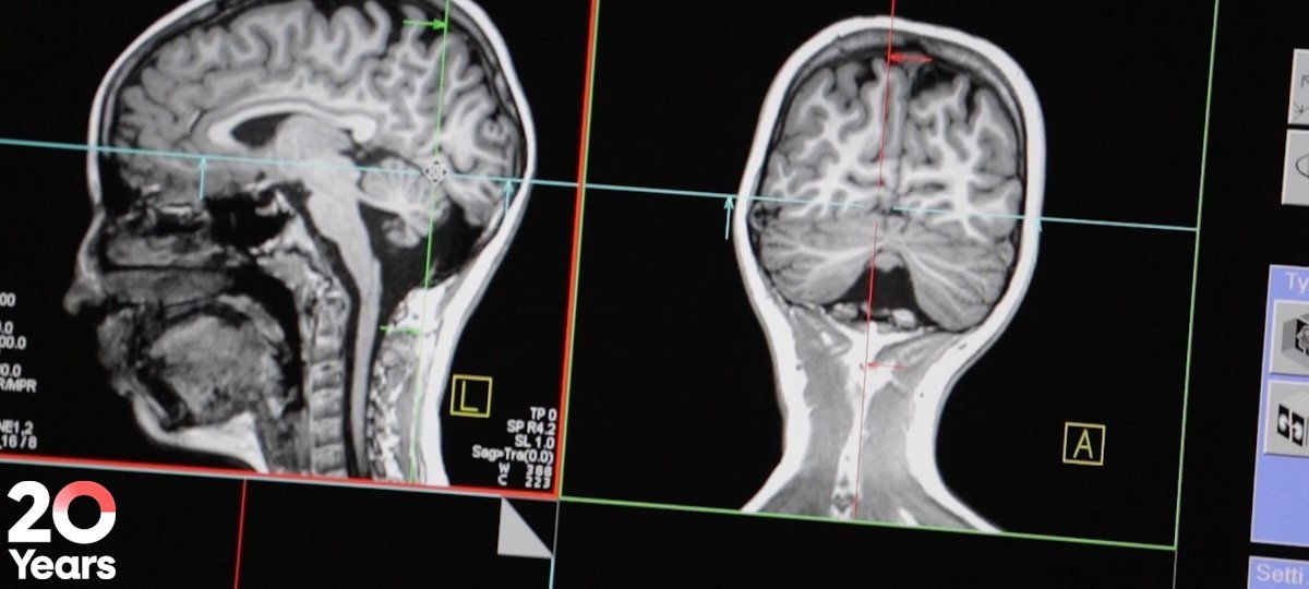 MRI scan of a brain with the NIHR 20 logo in bottom left corner