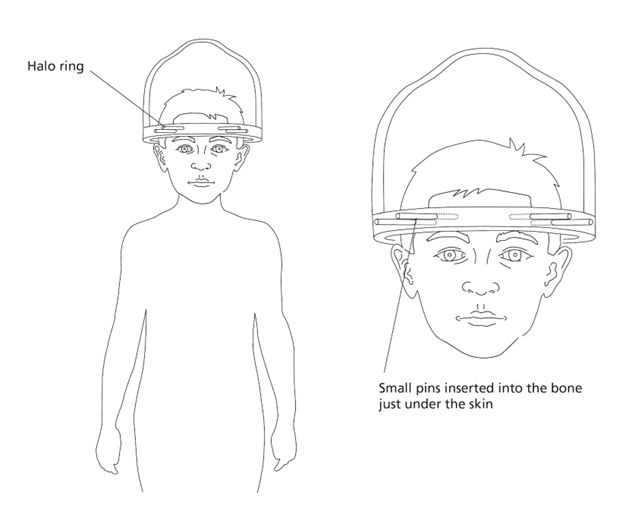 A child's head with a frame around and attached to it