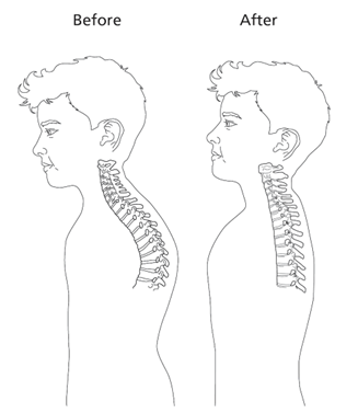 An illustration of a child's head and torso showing their spine curved, and then straightened