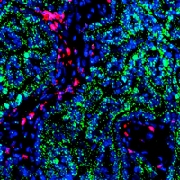 Kidney tumour under a microscope