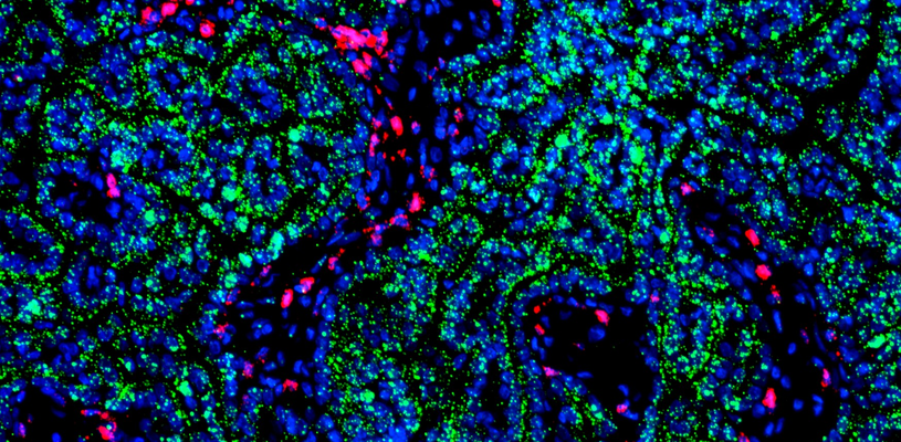 Kidney tumour under a microscope