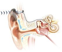 Diagram of a human ear with a cochlear implant. The external part is positioned behind the ear and transmits sound signals via a wire to an internal component surgically implanted inside the ear.