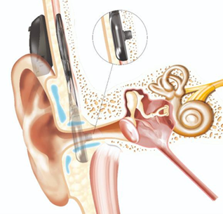 Medical illustration of a human ear with a cochlear implant. It shows the outer, middle, and inner ear structures. The implant is visible externally behind the ear and internally within the skull. A magnified inset highlights the internal components of the implant.