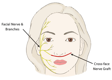 Image showing how the nerve is grafted onto the facial nerve. The cross-face nerve graft runs across the face, under the nose
