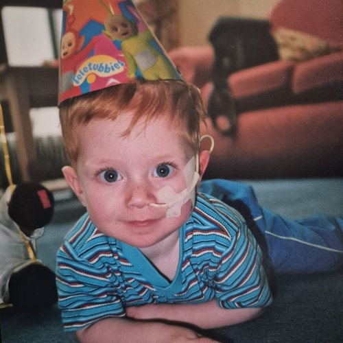 Young boy lying on front wearing a party hat with number 1 on it, smiling, with medical tube in nose.