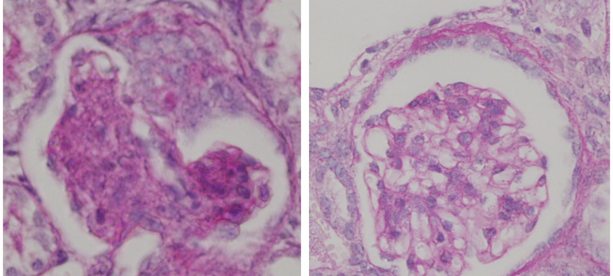 PAS (periodic acid–Schiff) stained glomeruli showing reduced scarring (deep pink) following ultrasound guided renal artery injection of Angpt1 nanocomplexes.