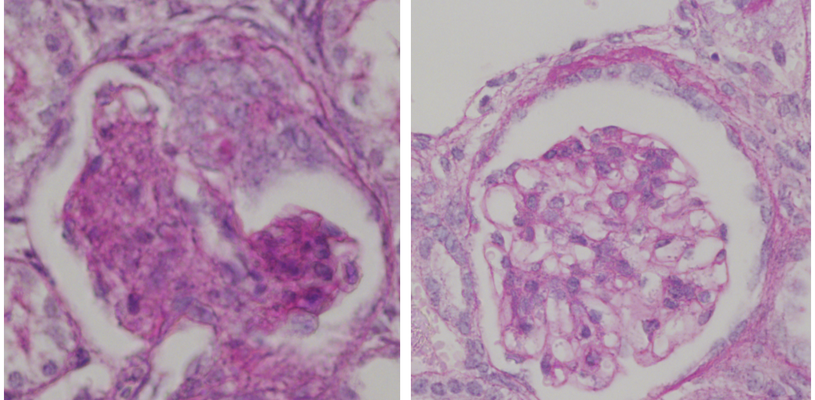 PAS (periodic acid–Schiff) stained glomeruli showing reduced scarring (deep pink) following ultrasound guided renal artery injection of Angpt1 nanocomplexes.