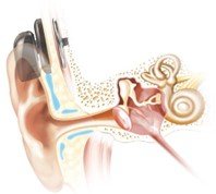 Anatomical illustration of the human ear showing the outer ear (pinna and ear canal), middle ear (eardrum and ossicles: malleus, incus, stapes), and inner ear (cochlea and semicircular canals). A hearing aid device is visible on the outer ear