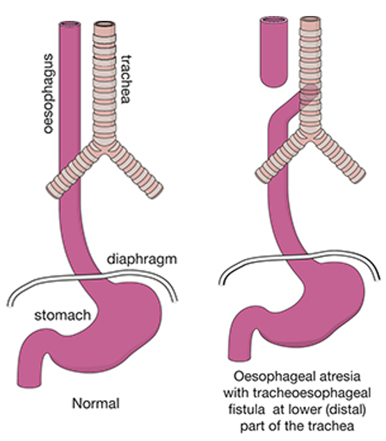 Diagram showing tracheo-oesophageal fistula. The top of the oesophagus is shown not connected to the stomach. Instead, the top of the oesophagus is shown joined to the windpipe