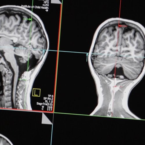 Image of an MRI result displaying the front and side of a skull in black and white