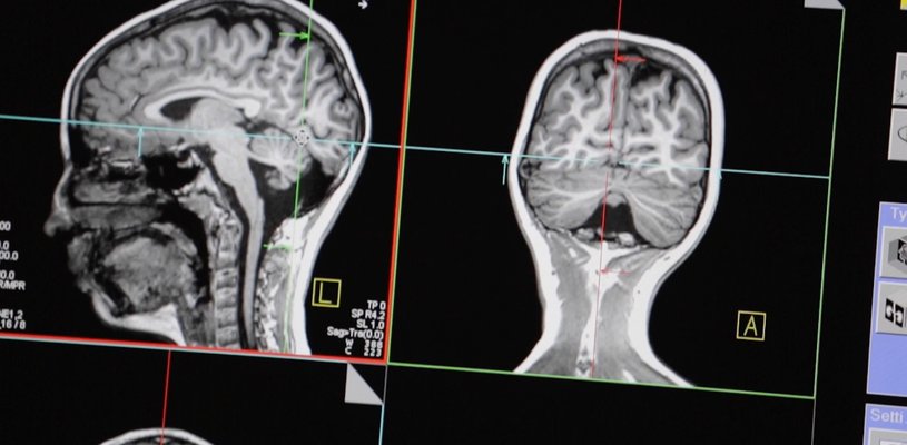 Image of an MRI result displaying the front and side of a skull in black and white