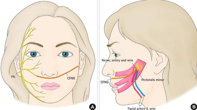 A diagram of a person's face, sowing a nerve under the nose, being connected with a nerve in the cheek