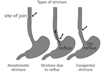 Diagram showing types of stricture. The oesophagus is shown as narrowed in one point.